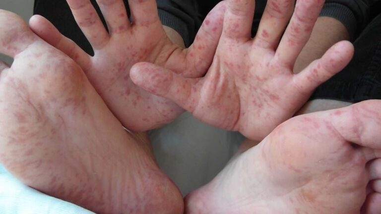 unam-emite-alerta-virus-coxsackie-oaxaca-reporta-dos-casos